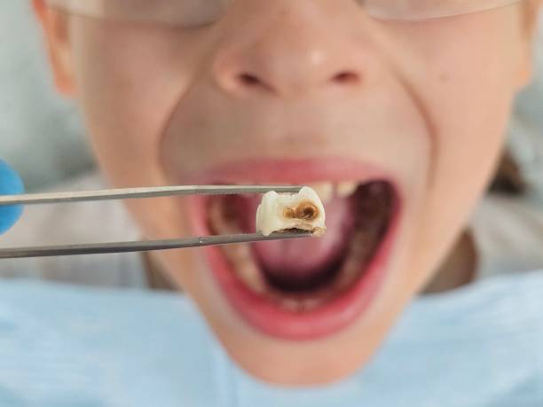 Best Urgent Dental Care for Toothache in Park Center, CO
