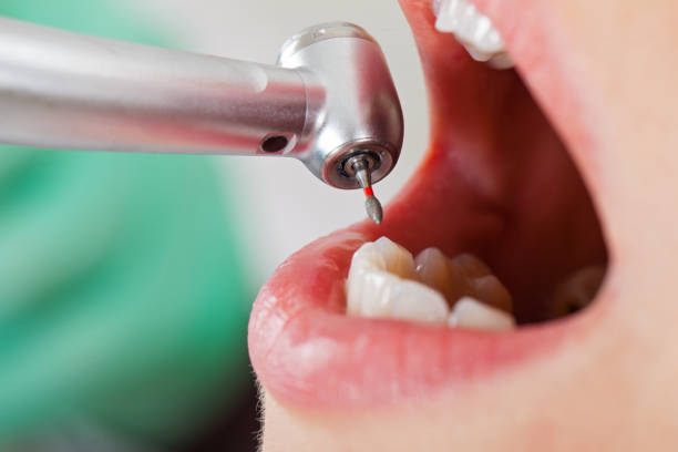 Best Emergency Dentist for Lost Fillings or Crowns in Park Center, CO